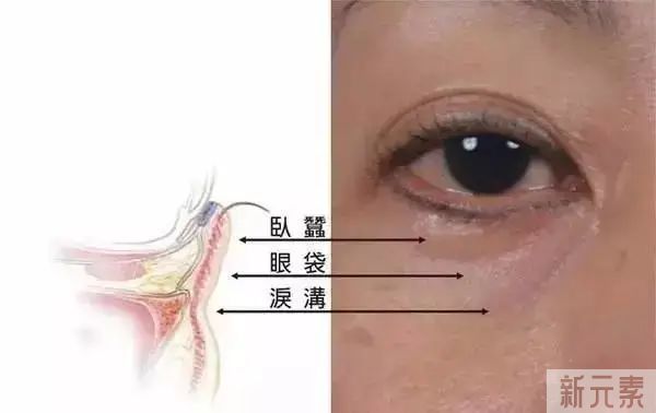 【医美小科普】去眼袋有哪些误区? 图片-1
