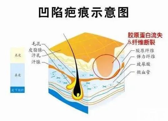 凹陷疤痕能恢复平整吗? 图片-3