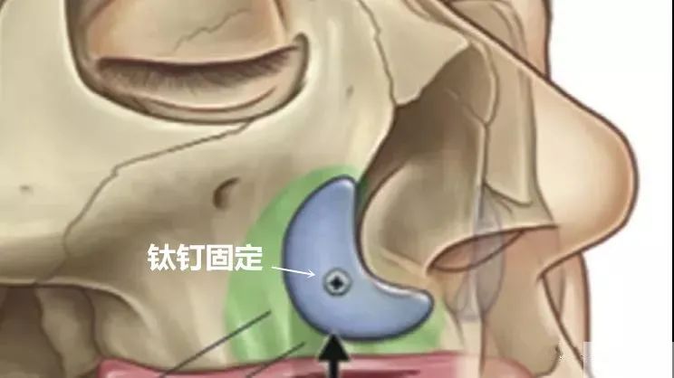 自测你需要垫鼻基底吗?看这一篇就够了 图片-5