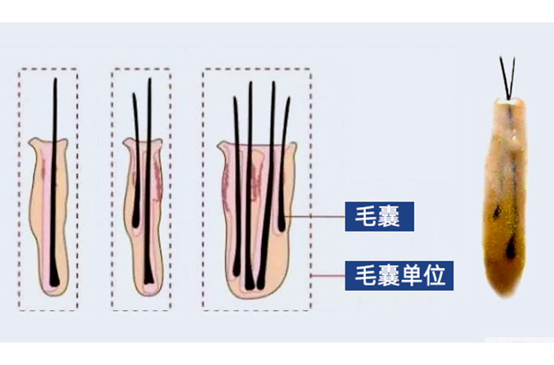 警惕“植发计费陷阱” ， 1 个毛囊≠1个毛囊单位 图片-2