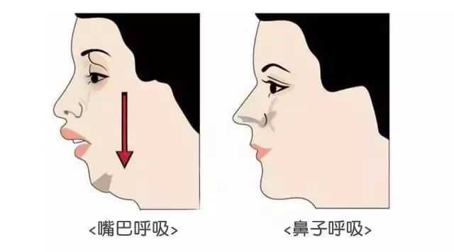 孩子的每一次口呼吸，都可能影响颜值... 图片-4