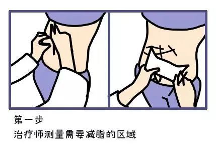 酷塑冷冻减脂，躺着就能瘦?到底是噱头还是黑科技? 图片-15
