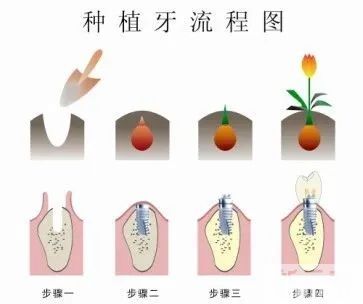 做种植牙前不得不问的3个问题，听听医生解读! 图片-7