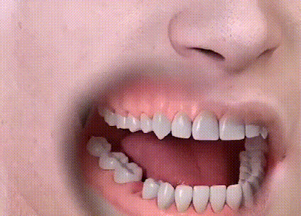 做种植牙前不得不问的3个问题，听听医生解读! 图片-14
