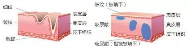 玻尿酸vs除皱针 可以联合使用吗? 图片-3