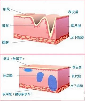 玻尿酸vs除皱针 可以联合使用吗? 图片-6