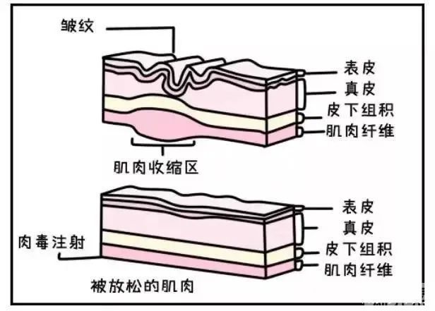 玻尿酸vs除皱针 可以联合使用吗? 图片-5