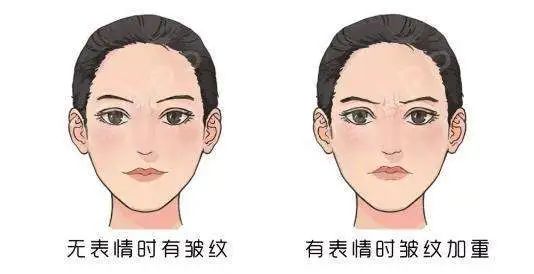 玻尿酸vs除皱针 可以联合使用吗? 图片-2