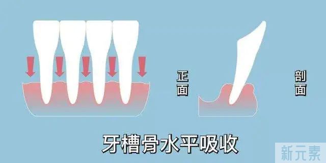 缺牙后如何避免骨吸收?我们从3种修复方式的吸收数据中找到了答案! 图片-4