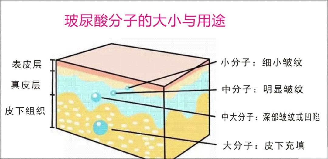 一分钟带你了解微整之玻尿酸的正确打开方式 图片-2