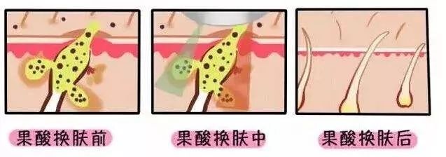 果酸焕肤到底如何?做完皮肤会变薄? 图片-11