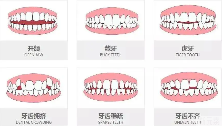 牙齿矫正那些事你真的了解么? 图片-4