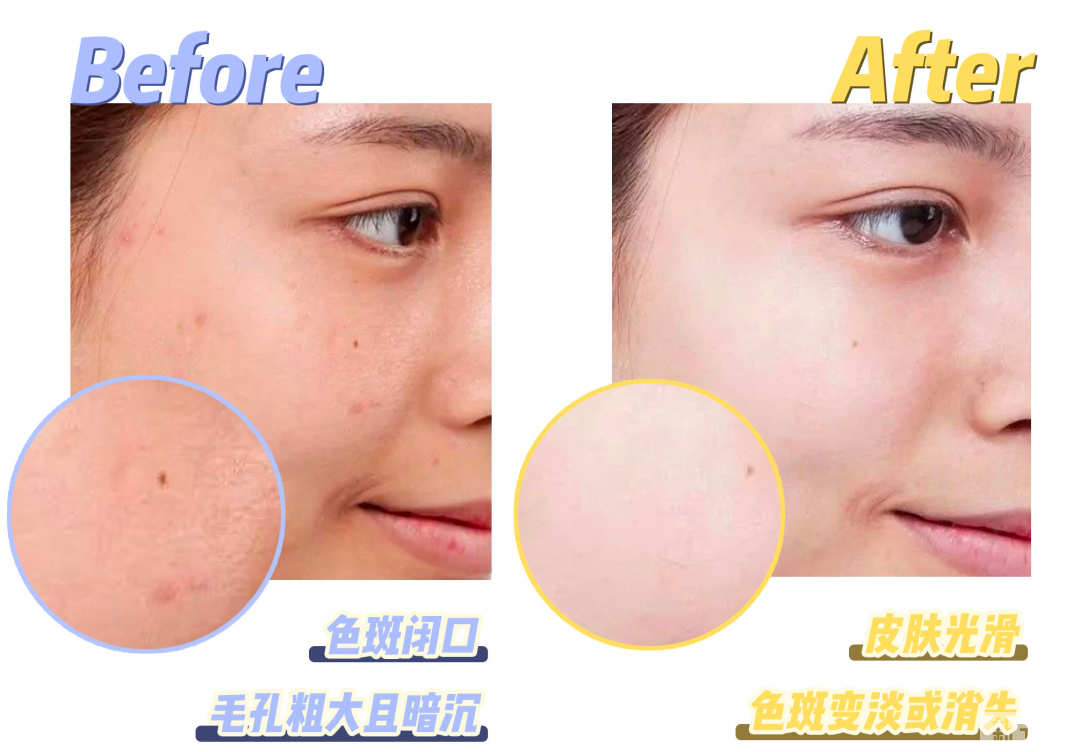面对夏日皮肤出油等各种问题，应该怎样养成一张干净的脸呢? 图片-6