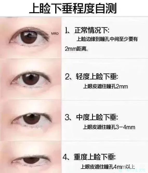 眼睛总是睁不开?有可能是上睑下垂! 图片-3