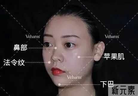 玻尿酸≠假面感，填充后更具高级感?! 图片-7
