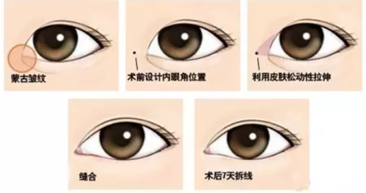 做了双眼皮为什么还要开眼角? 图片-3