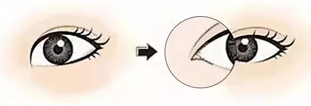 做了双眼皮为什么还要开眼角? 图片-11
