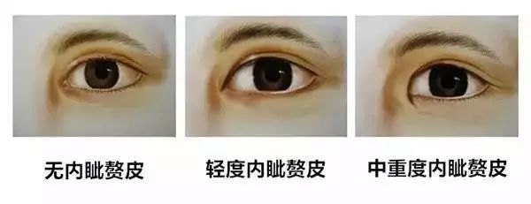 做了双眼皮为什么还要开眼角? 图片-6