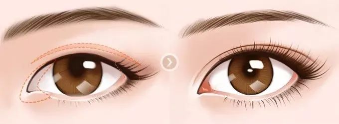 做了双眼皮为什么还要开眼角? 图片-10