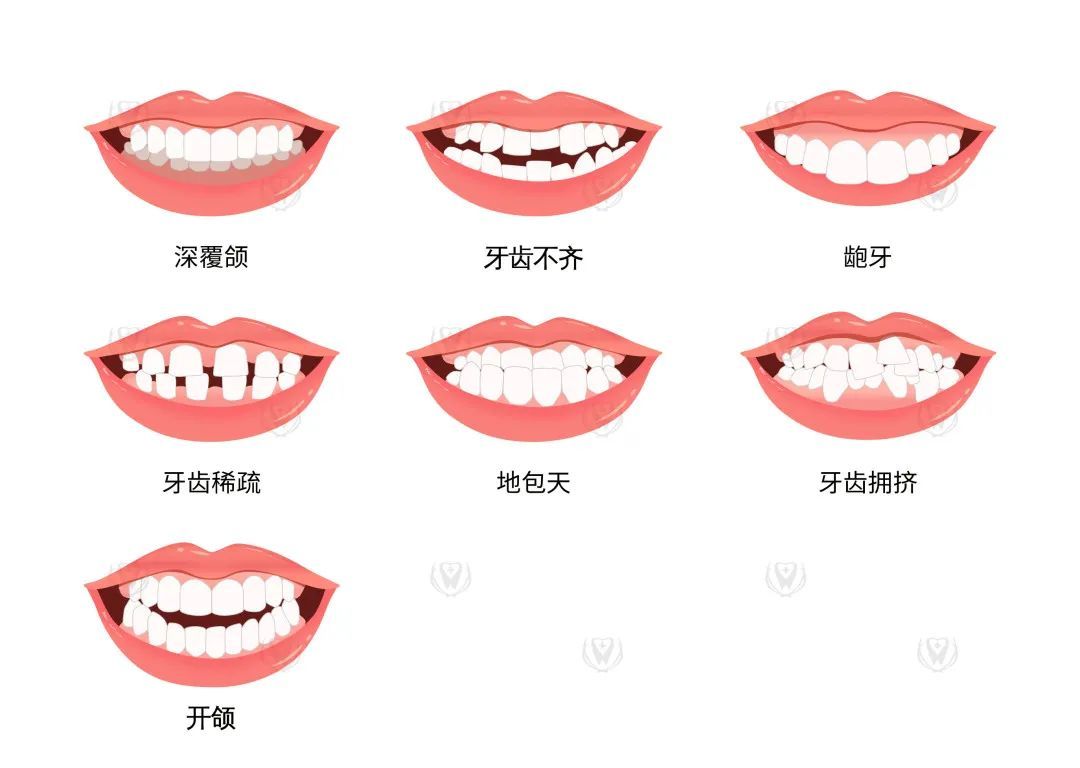 收下这份矫牙前须知5大流程指南!让你矫牙不迷路! 图片-4