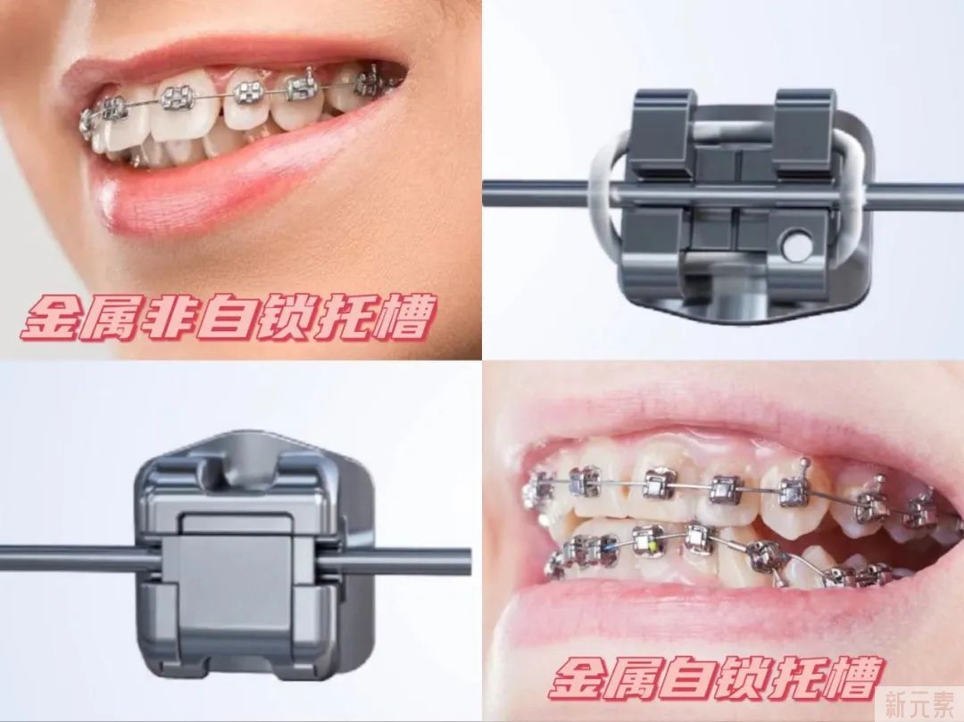 收下这份矫牙前须知5大流程指南!让你矫牙不迷路! 图片-9