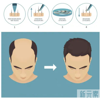 植发后这些细节不可忽视~ 图片-4