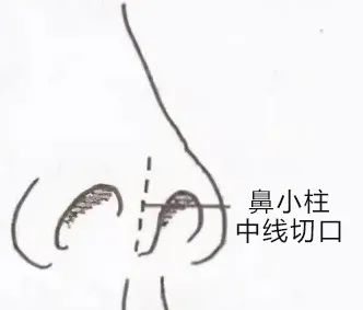 避坑| 这些功课才是「有效隆鼻」该做的 图片-5