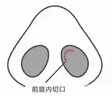 避坑| 这些功课才是「有效隆鼻」该做的 图片-7
