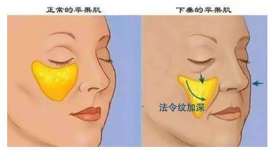 苹果肌、法令纹凹陷，要如何改善? 图片-3