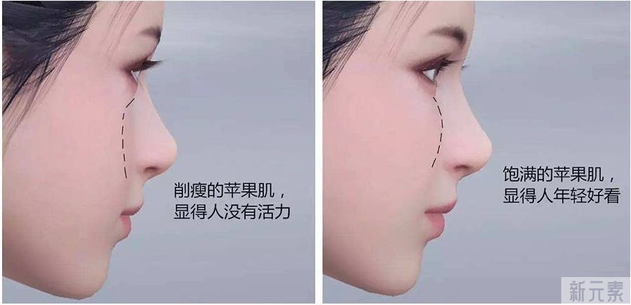 苹果肌、法令纹凹陷，要如何改善? 图片-5