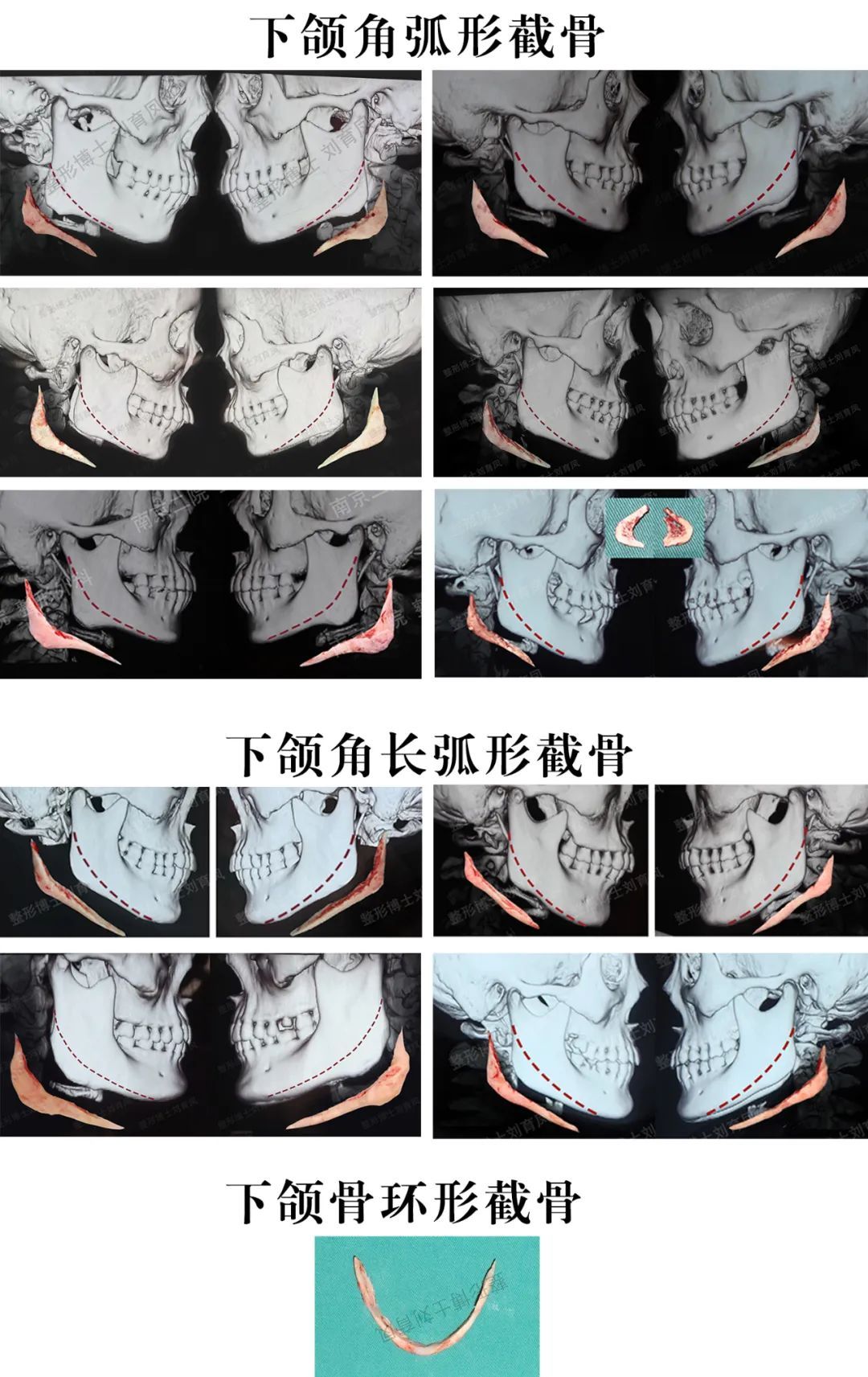 【零零后暑期整形科普系列】之面部轮廓整形 图片-7