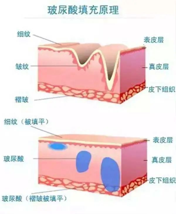 打完玻尿酸，怎么护理才能让效果维持得更久? 图片-3