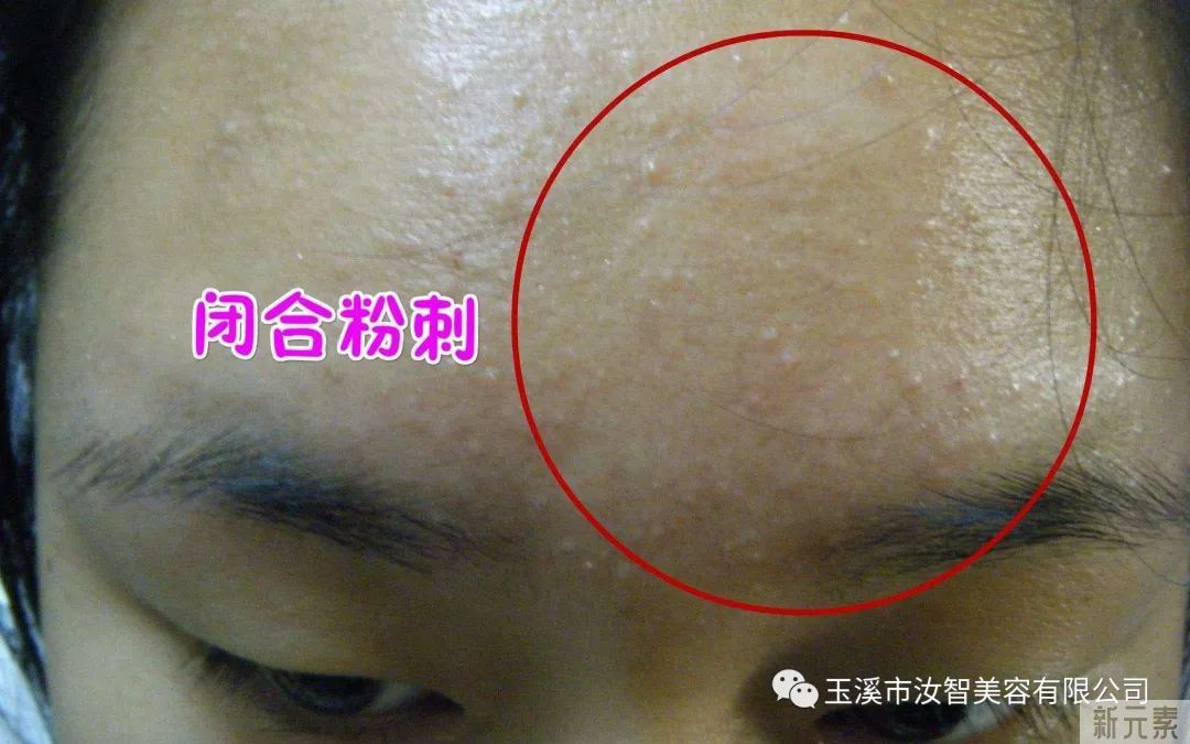 从满脸痘痘到皮肤光滑，我做了这些事。 图片-5