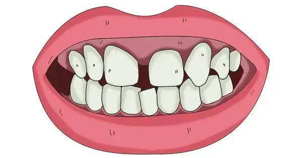 牙缝大怎么办?是做矫正还是做贴面? 图片-2