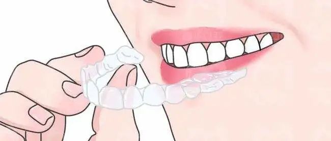 牙缝大怎么办?是做矫正还是做贴面? 图片-5