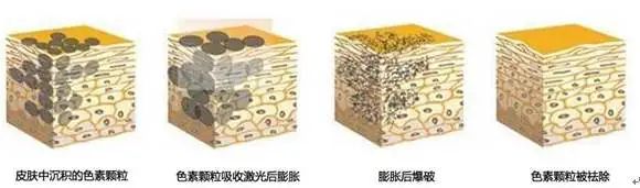 激光功能多治疗范围广，祛除面部这种痣目前是首选 图片-4