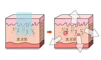 激光功能多治疗范围广，祛除面部这种痣目前是首选 图片-5