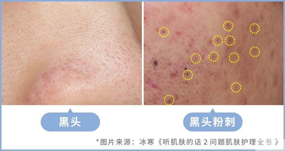 夏日黑头大作战，用对方法轻松甩掉! 图片-3