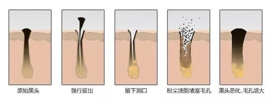 夏日黑头大作战，用对方法轻松甩掉! 图片-1