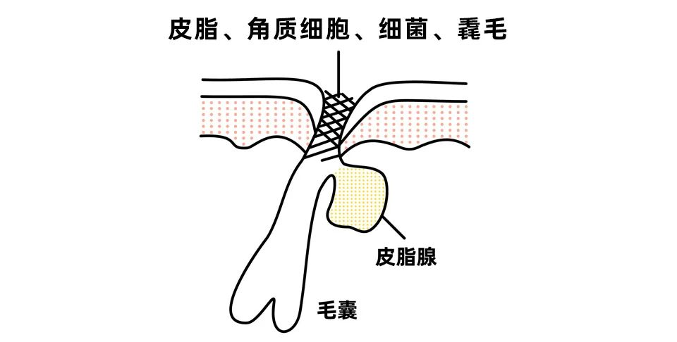 夏日黑头大作战，用对方法轻松甩掉! 图片-2