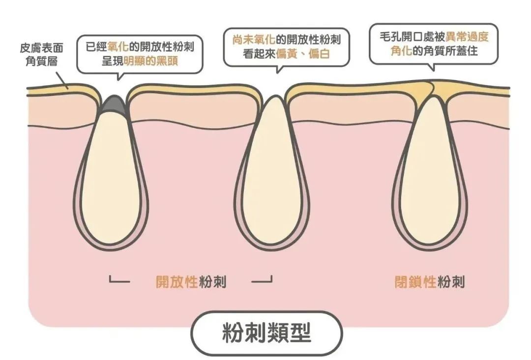 夏日黑头大作战，用对方法轻松甩掉! 图片-4