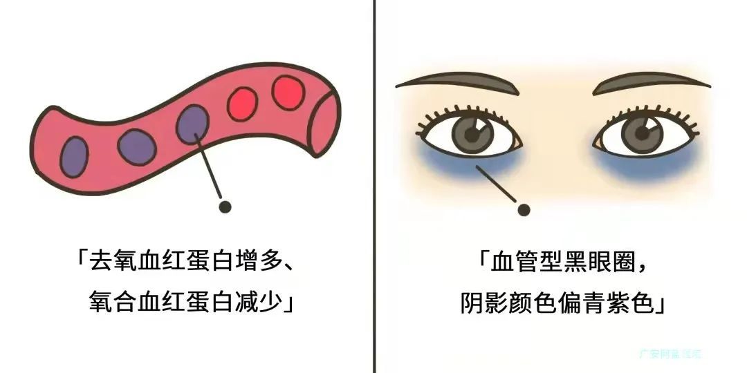 黑眼圈、不一定都是熬夜的锅 图片-2