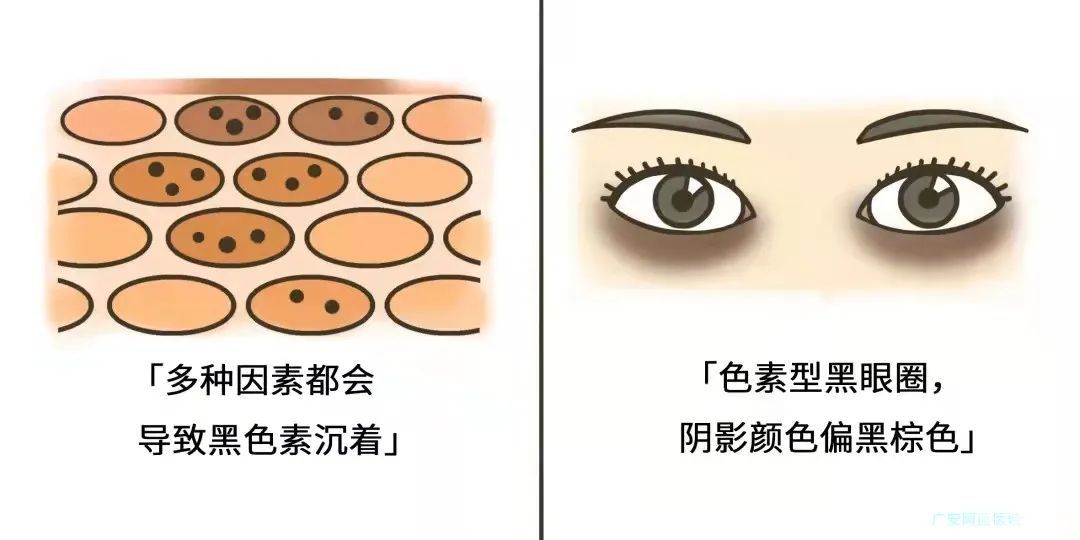 黑眼圈、不一定都是熬夜的锅 图片-1