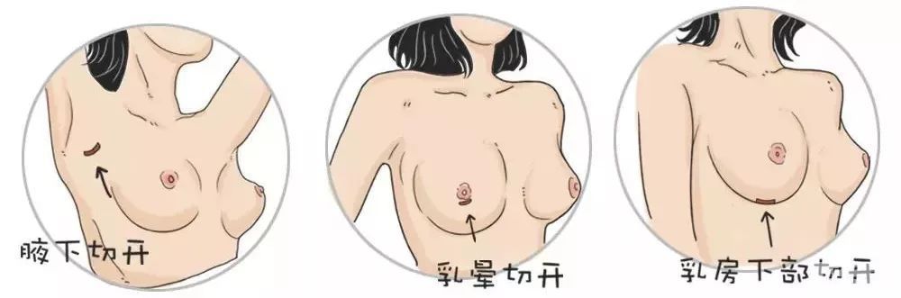 假体隆胸前你需要知道的几件事 图片-5