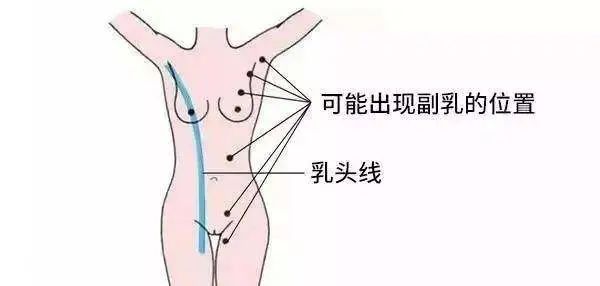 副乳是什么?该怎么消除? 图片-5