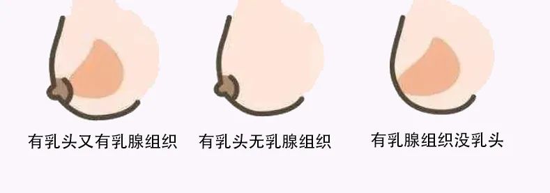 副乳是什么?该怎么消除? 图片-10