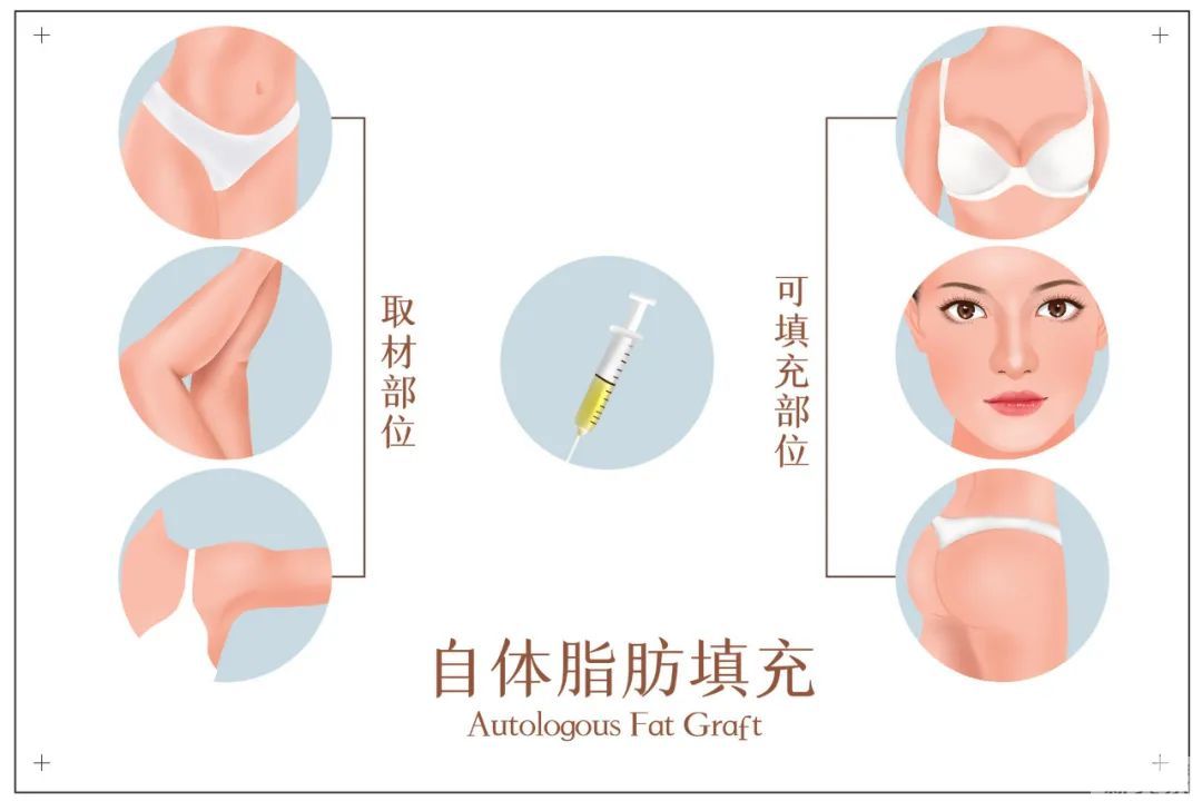 一次手术解决四大“面子”问题，自体脂肪面部填充你了解多少? 图片-5