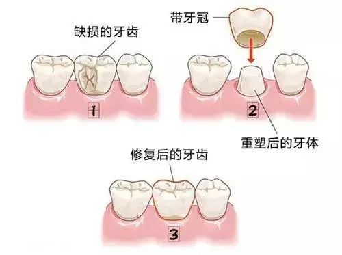 根管治疗后，牙齿可以“存活”多少年? 图片-8