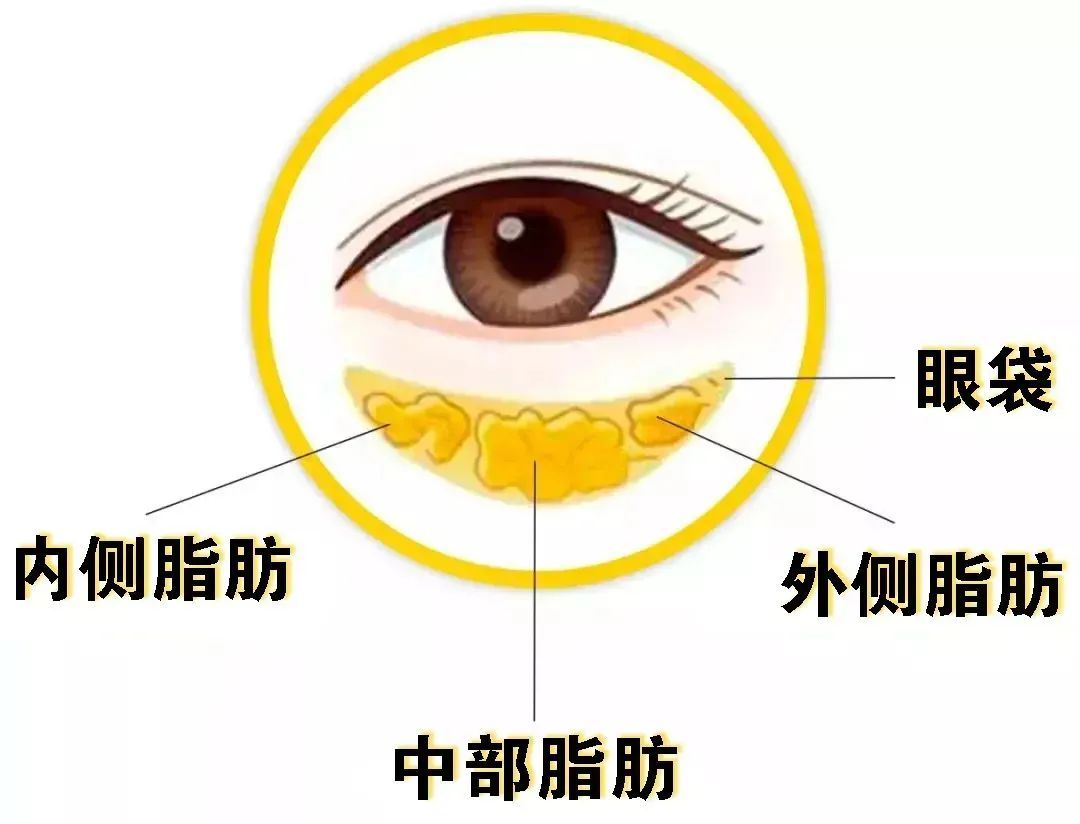 改善眼袋，绕不开这3种方法 图片-4