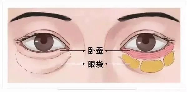 改善眼袋，绕不开这3种方法 图片-10